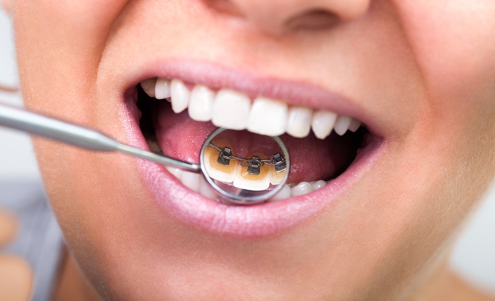 7 idées reçues sur les facettes dentaires
